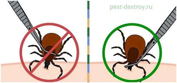 Достать клеща с помощью масла. Как правильно вытащить присосавшегося клеща у человека